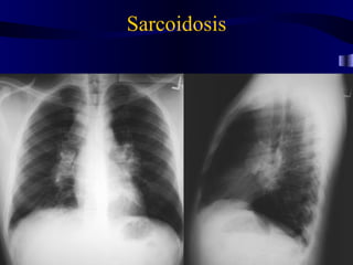 Sarcoidosis
 