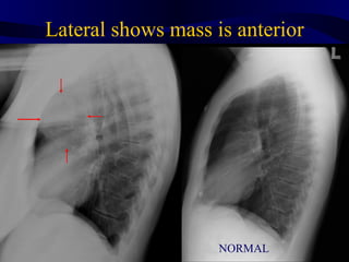 Lateral shows mass is anterior




                    NORMAL
 