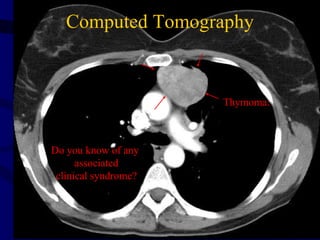 Computed Tomography


                      Thymoma:



Do you know of any
      associated
 clinical syndrome?
 