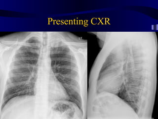 Presenting CXR
 