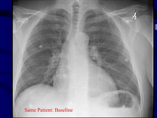 baseline




Same Patient: Baseline
 