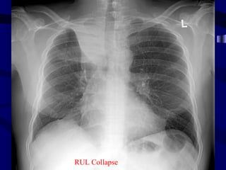 Rul collapse




RUL Collapse
 