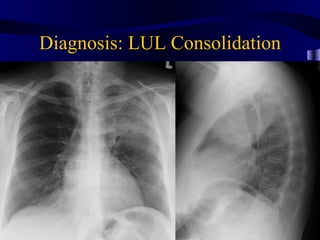 Diagnosis: LUL Consolidation
 