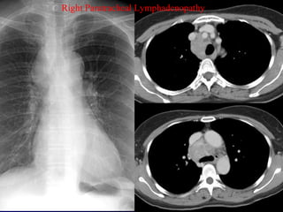 Right Paratracheal Lymphadenopathy
 