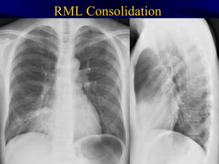 RML Consolidation
 Rml consolidation
 