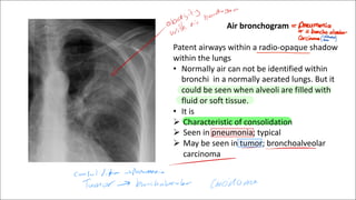 Chest imaging part one radiology lecture .pdf
