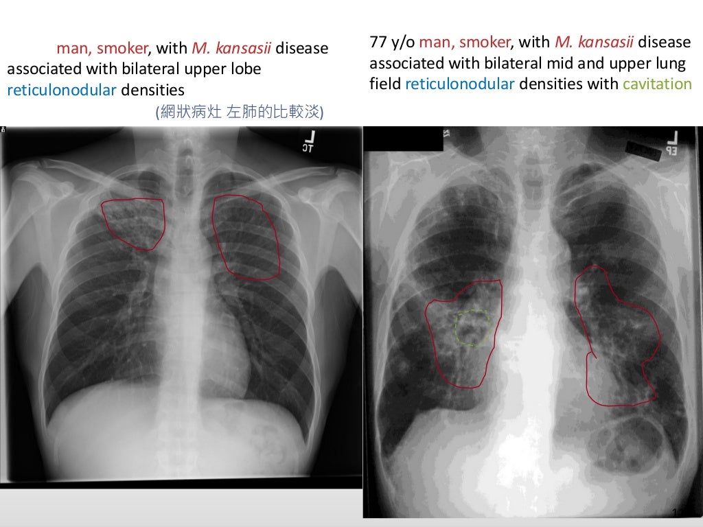 Chest imaging of ntm pulmonary disease2