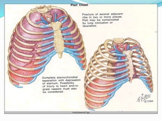 Chest Fragmentation Injuries Chest injuries | PPTX