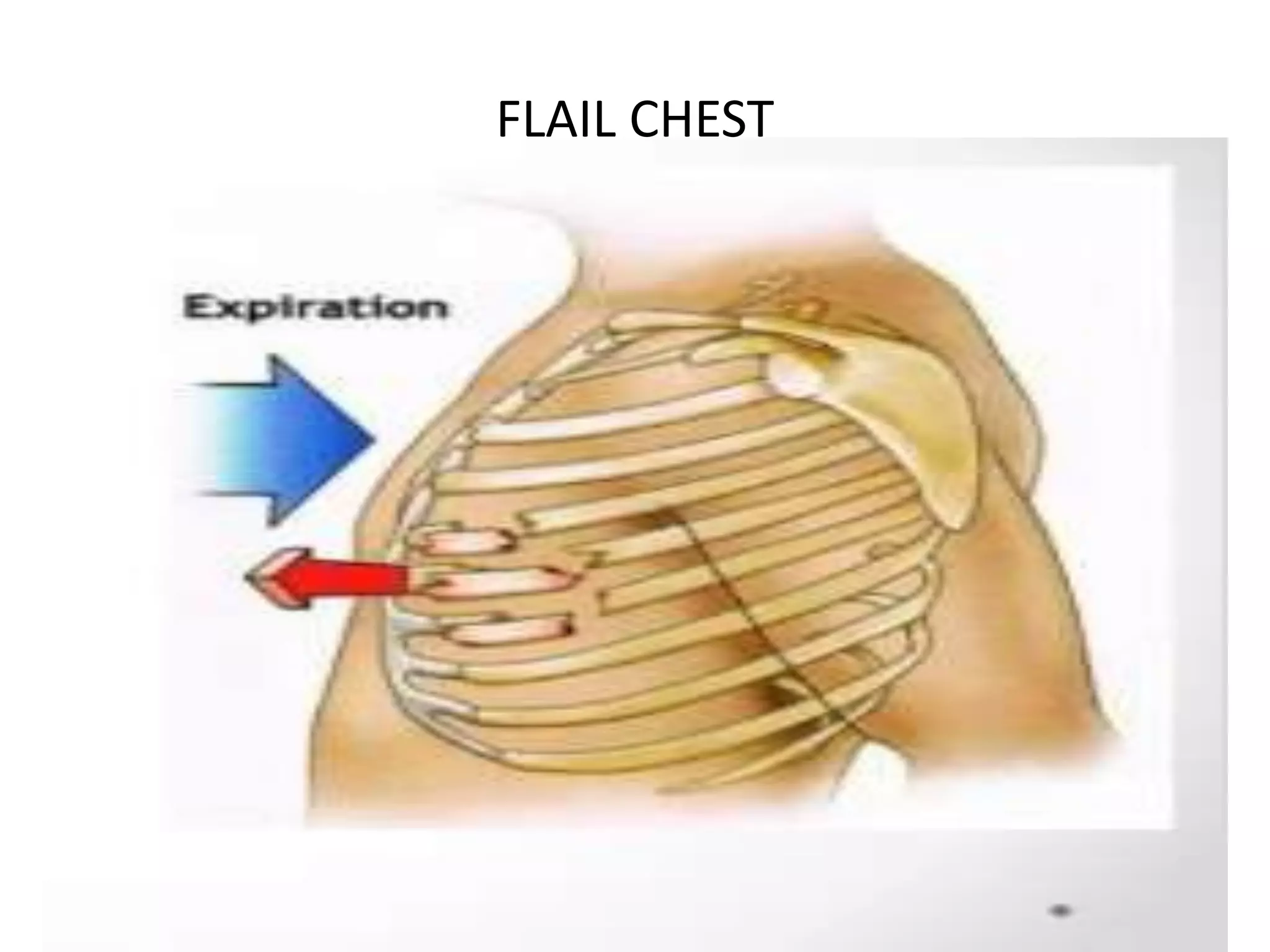 CHEST INJURIES.pptx