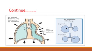 Chest injuries, complications and management pptx | PPTX