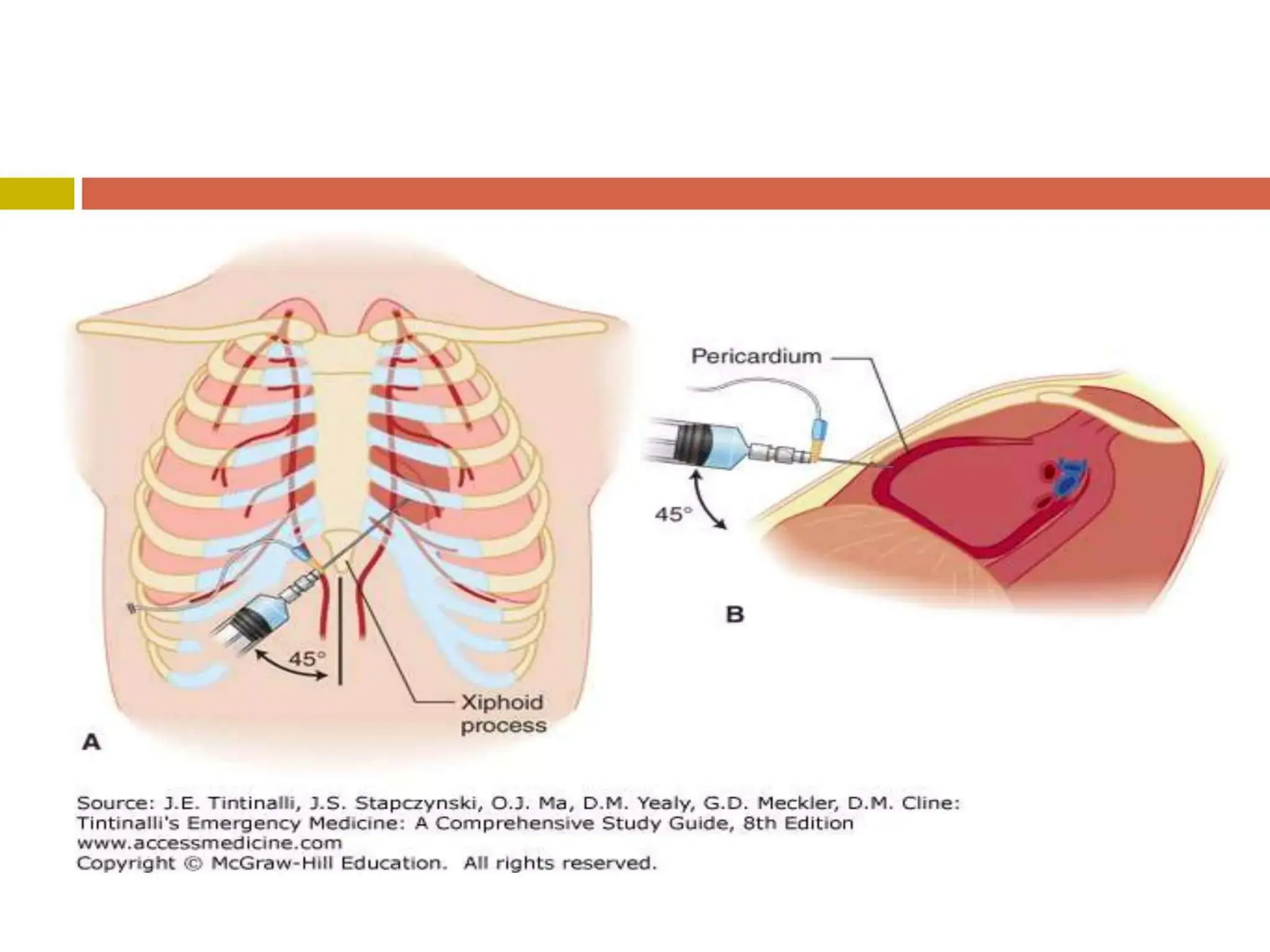 chest injuries, blunt injury, penetrating injury | PDF