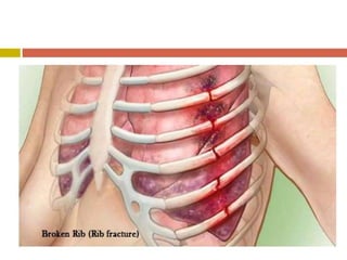 chest injuries, blunt injury, penetrating injury | PDF