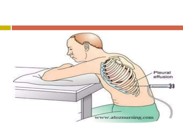 chest injuries, blunt injury, penetrating injury | PDF