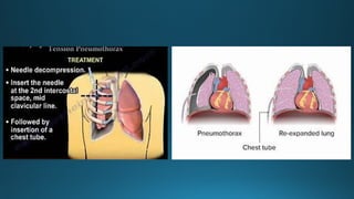 chest injuries chest injuries chest injuries.pptx