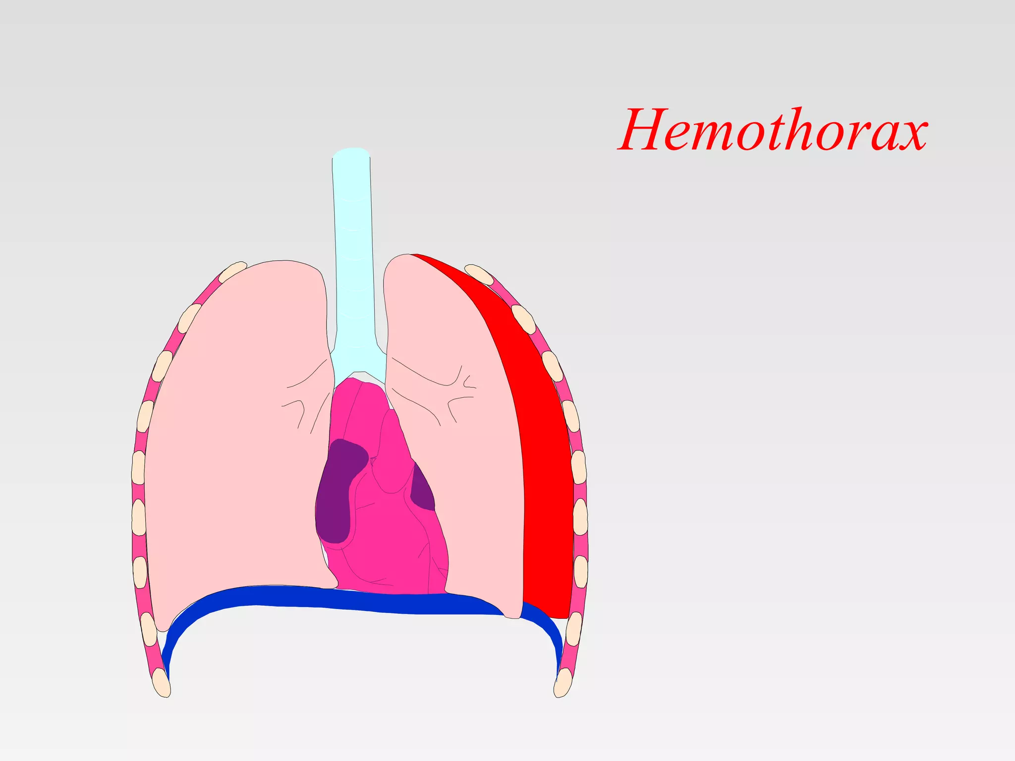 Chest Injuries And Hemothorax pptx Chest Injuries And Hemothorax pptx