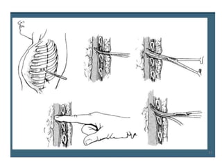 chest injuries and the patient management | PPTX