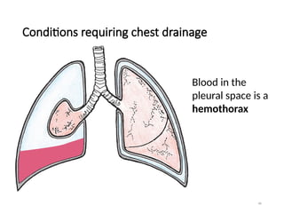 46
Conditions requiring chest drainage
Blood in the
pleural space is a
hemothorax
 