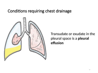 47
Conditions requiring chest drainage
Transudate or exudate in the
pleural space is a pleural
effusion
 