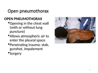 49
Open pneumothorax
OPEN PNEUMOTHORAX
Opening in the chest wall
(with or without lung
puncture)
Allows atmospheric air to
enter the pleural space
Penetrating trauma: stab,
gunshot, impalement
Surgery
 