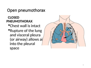 50
Open pneumothorax
CLOSED
PNEUMOTHORAX
Chest wall is intact
Rupture of the lung
and visceral pleura
(or airway) allows air
into the pleural
space
 