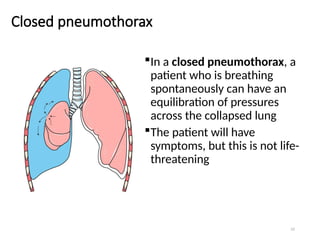 52
Closed pneumothorax
In a closed pneumothorax, a
patient who is breathing
spontaneously can have an
equilibration of pressures
across the collapsed lung
The patient will have
symptoms, but this is not life-
threatening
 