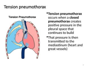 54
Tension pneumothorax
Tension pneumothorax
occurs when a closed
pneumothorax creates
positive pressure in the
pleural space that
continues to build
That pressure is then
transmitted to the
mediastinum (heart and
great vessels)
 