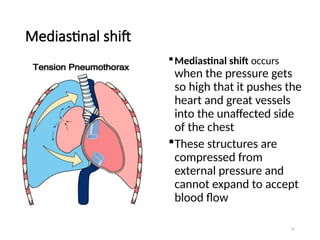 55
Mediastinal shift
Mediastinal shift occurs
when the pressure gets
so high that it pushes the
heart and great vessels
into the unaffected side
of the chest
These structures are
compressed from
external pressure and
cannot expand to accept
blood flow
 