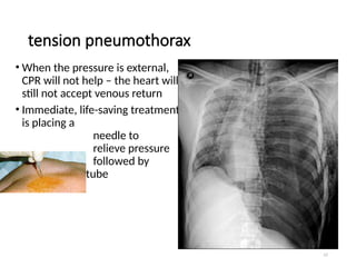 57
tension pneumothorax
• When the pressure is external,
CPR will not help – the heart will
still not accept venous return
• Immediate, life-saving treatment
is placing a
needle to
relieve pressure
followed by
chest tube
 