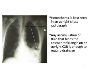 59
Hemothorax is best seen
in an upright chest
radiograph
Any accumulation of
fluid that hides the
costophrenic angle on an
upright CXR is enough to
require drainage
Note air/fluid meniscus
 