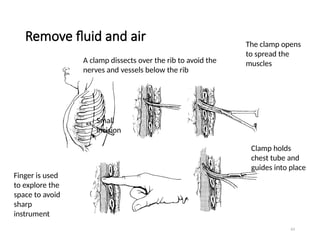 63
Remove fluid and air
A clamp dissects over the rib to avoid the
nerves and vessels below the rib
Small
incision
The clamp opens
to spread the
muscles
Finger is used
to explore the
space to avoid
sharp
instrument
Clamp holds
chest tube and
guides into place
 