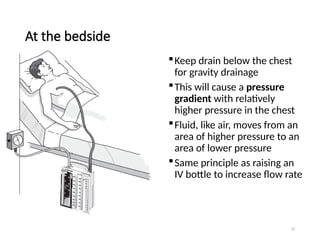 74
At the bedside
Keep drain below the chest
for gravity drainage
This will cause a pressure
gradient with relatively
higher pressure in the chest
Fluid, like air, moves from an
area of higher pressure to an
area of lower pressure
Same principle as raising an
IV bottle to increase flow rate
 