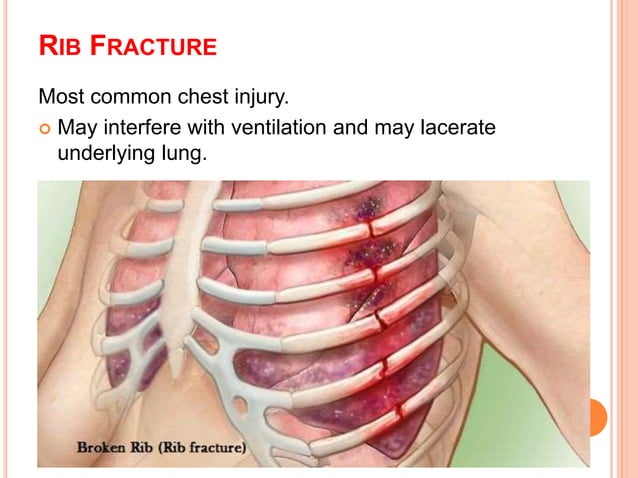 Chest injury and nursing care | PPTX | Death, Injury, or Military ...