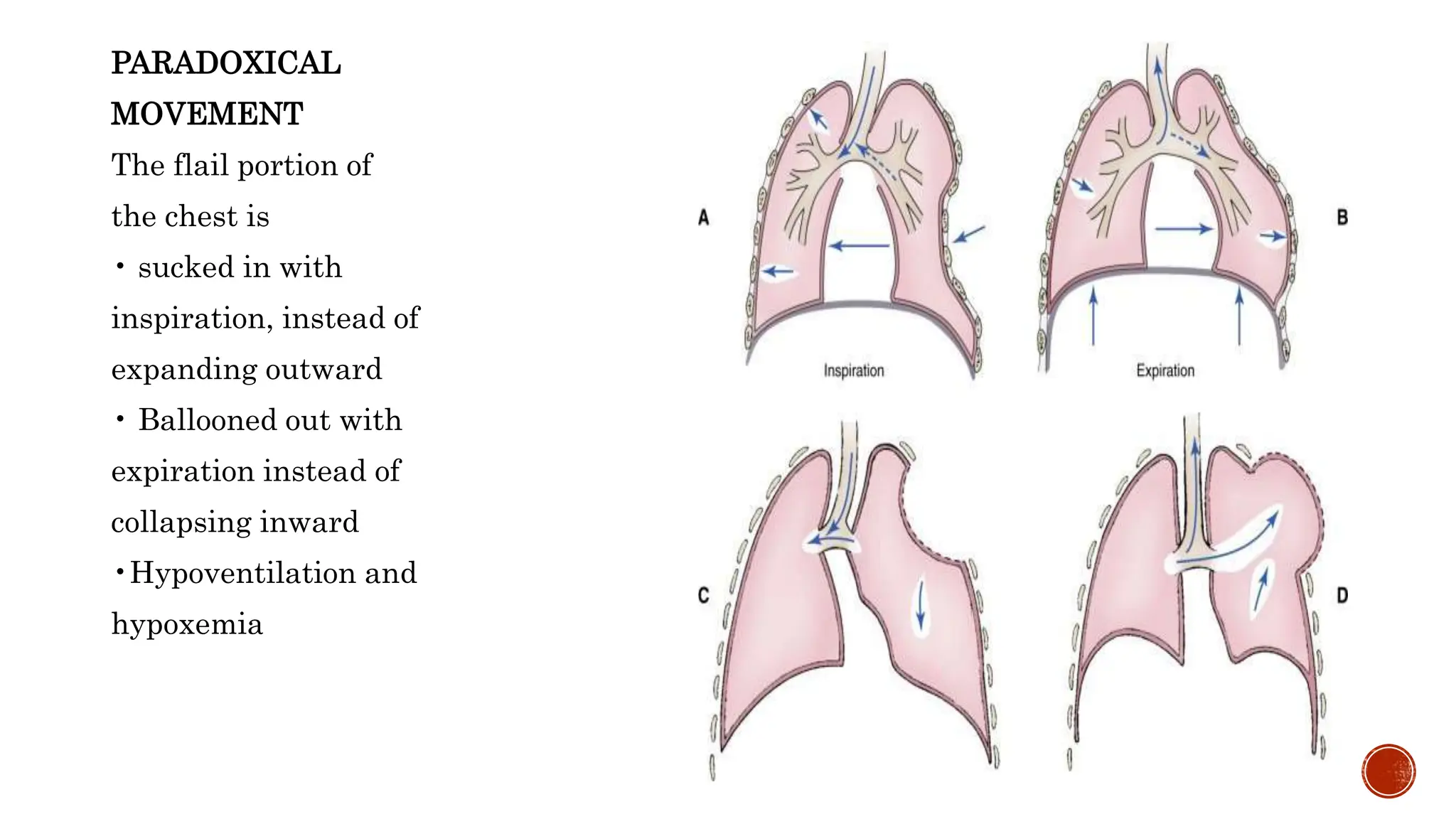 Chest Injury pptx Hemothorax Pneumothorax Management PPTX