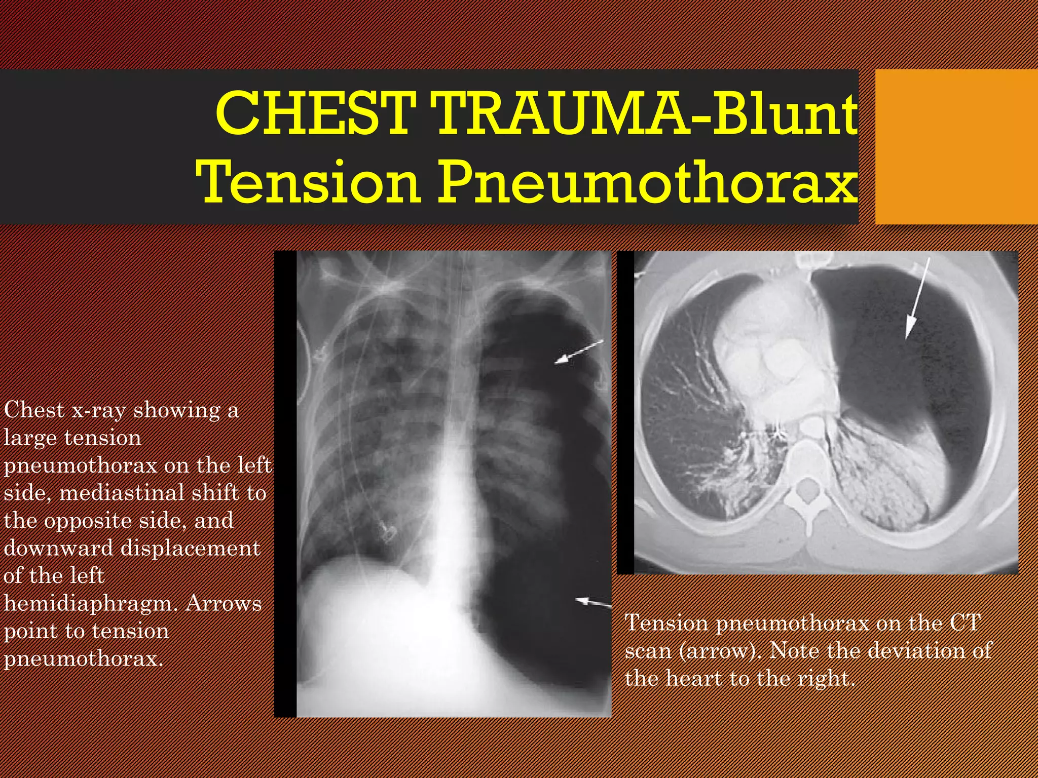 CHEST INJURY- BLUNT- Trauma Surgery | PPT