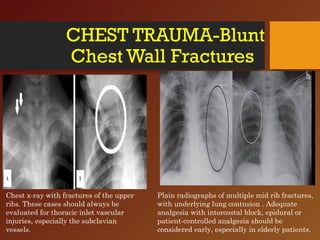 CHEST TRAUMA-Blunt
Chest Wall Fractures
Chest x-ray with fractures of the upper
ribs. These cases should always be
evaluated for thoracic inlet vascular
injuries, especially the subclavian
vessels.
Plain radiographs of multiple mid rib fractures,
with underlying lung contusion . Adequate
analgesia with intercostal block, epidural or
patient-controlled analgesia should be
considered early, especially in elderly patients.
 