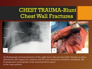 CHEST TRAUMA-Blunt
Chest Wall Fractures
(A) Radiograph showing fractures of the right lower ribs (arrows) (left). Injuries to intra-
abdominal solid organs are common and CT scan evaluation should be considered. (B)
Intraoperative photograph of the associated liver injury
in the same patient.
 