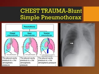 CHEST TRAUMA-Blunt
Simple Pneumothorax
 