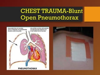 CHEST TRAUMA-Blunt
Open Pneumothorax
 