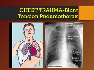 CHEST TRAUMA-Blunt
Tension Pneumothorax
 