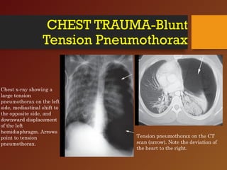 CHEST TRAUMA-Blunt
Tension Pneumothorax
Chest x-ray showing a
large tension
pneumothorax on the left
side, mediastinal shift to
the opposite side, and
downward displacement
of the left
hemidiaphragm. Arrows
point to tension
pneumothorax.
Tension pneumothorax on the CT
scan (arrow). Note the deviation of
the heart to the right.
 