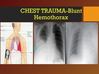 CHEST TRAUMA-Blunt
Hemothorax
 