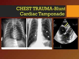 CHEST TRAUMA-Blunt
Cardiac Tamponade
 