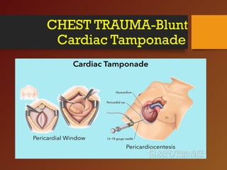 CHEST TRAUMA-Blunt
Cardiac Tamponade
 