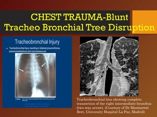CHEST TRAUMA-Blunt
Tracheo Bronchial Tree Disruption
Tracheobronchial tree showing complete
transection of the right intermediate bronchus
(two-way arrow). (Courtesy of Dr Montserrat
Bret, University Hospital La Paz, Madrid)
 