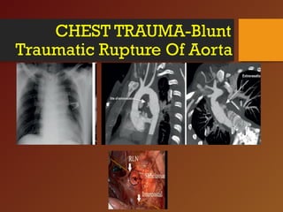 CHEST TRAUMA-Blunt
Traumatic Rupture Of Aorta
 