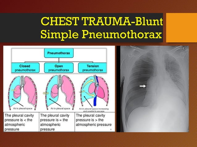 Blunt Trauma Related Chest Wall And Pulmonary Injuries: An Overview – UWNF