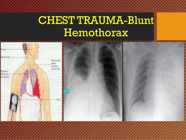 CHEST INJURY- BLUNT- Trauma Surgery