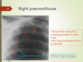 •Pencil-thin white line
running parallel to chest
wall
•No lung markings lateral
to the line
Blade of right scapula
Right pneumothorax
5/29/2023
38
 
