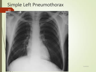 Simple Left Pneumothorax
5/29/2023
39
 