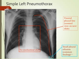Simple Left Pneumothorax
No mediastinal shift
Small pleural
effusion
(common
finding)
Visceral
pleural line
(zoomed
view on next
slide)
5/29/2023
40
 